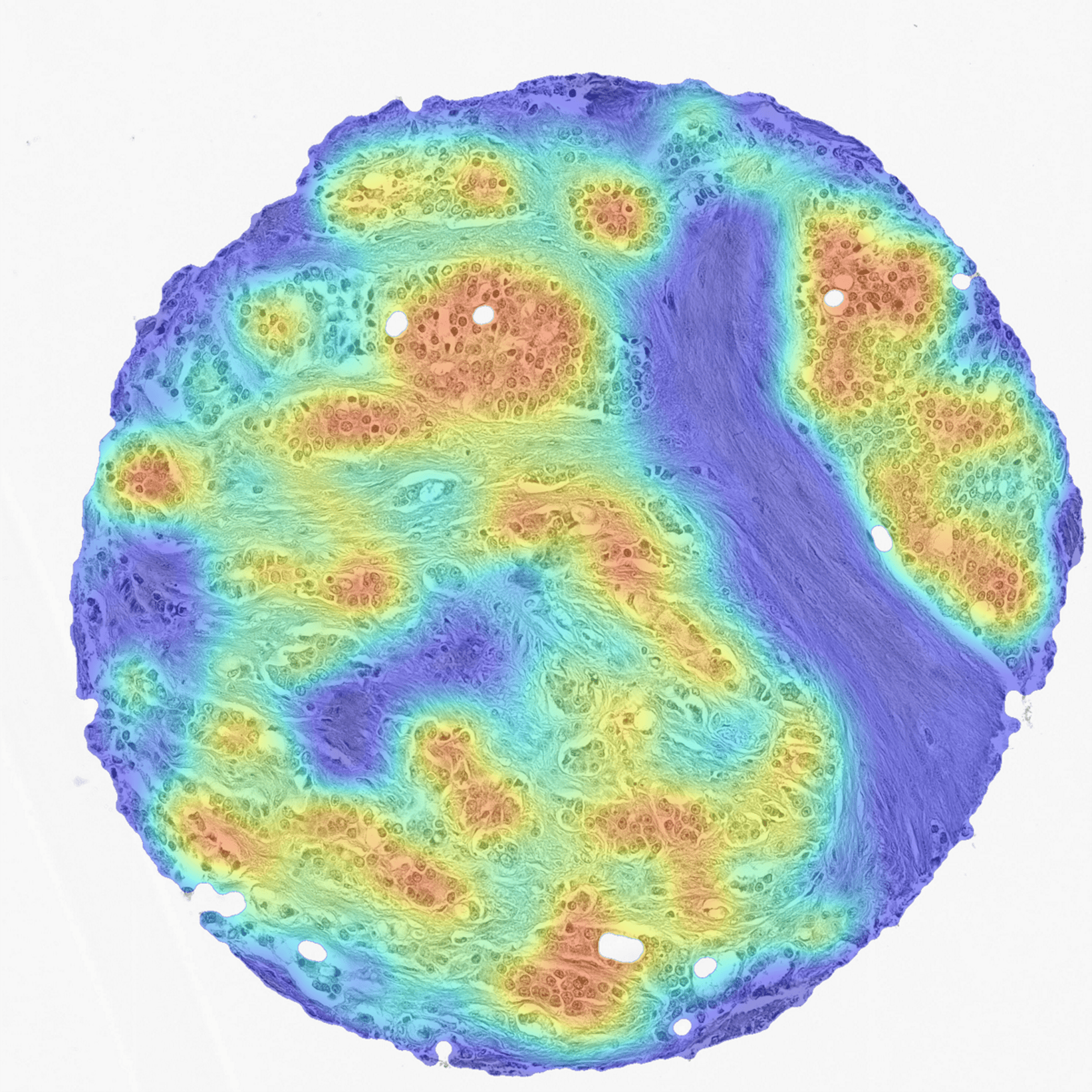 Title image for AI grading of prostate cancer